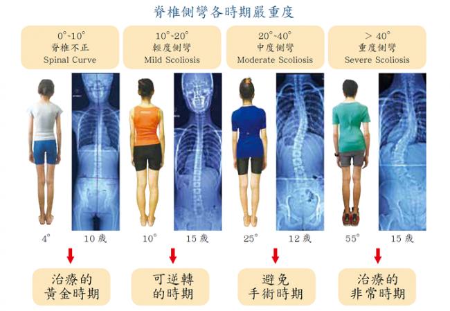 脊椎側彎各時期的延重程度案例