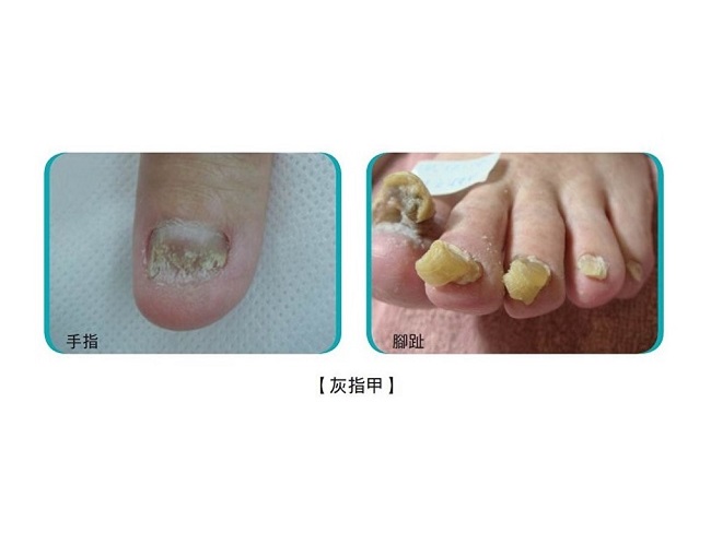 灰指甲又稱臭甲