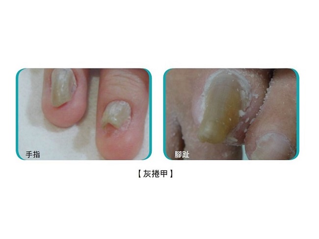 捲灰甲