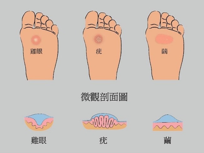 雞眼常被當成疣