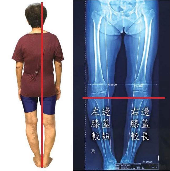 膝蓋外翻個案