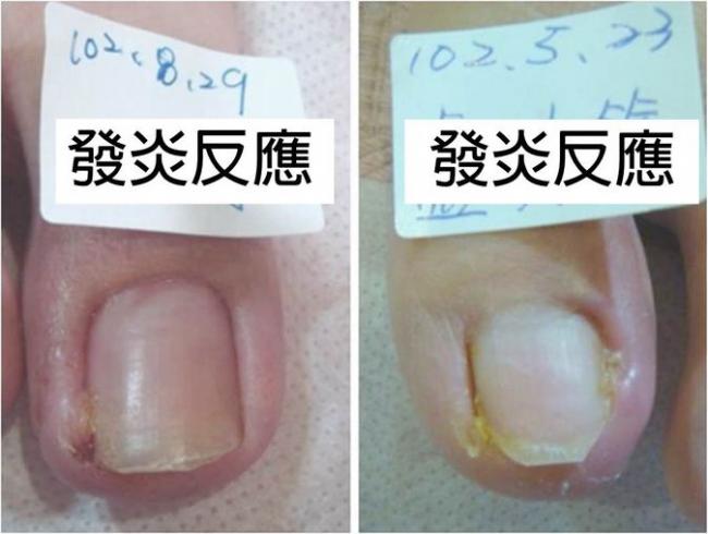嵌甲引起的發炎反應