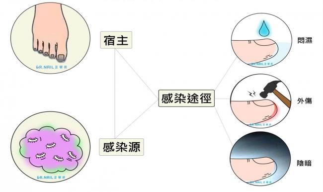灰指甲感染途徑