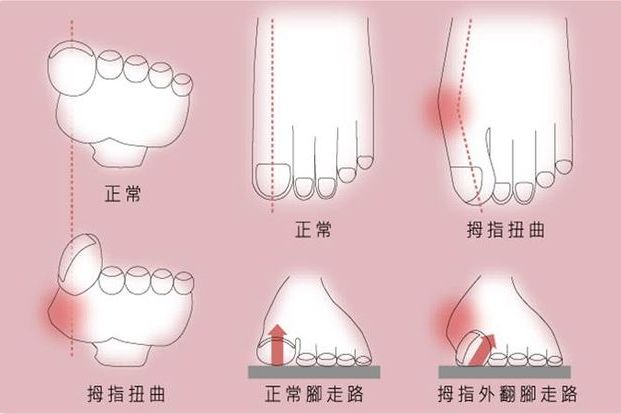 拇指外翻