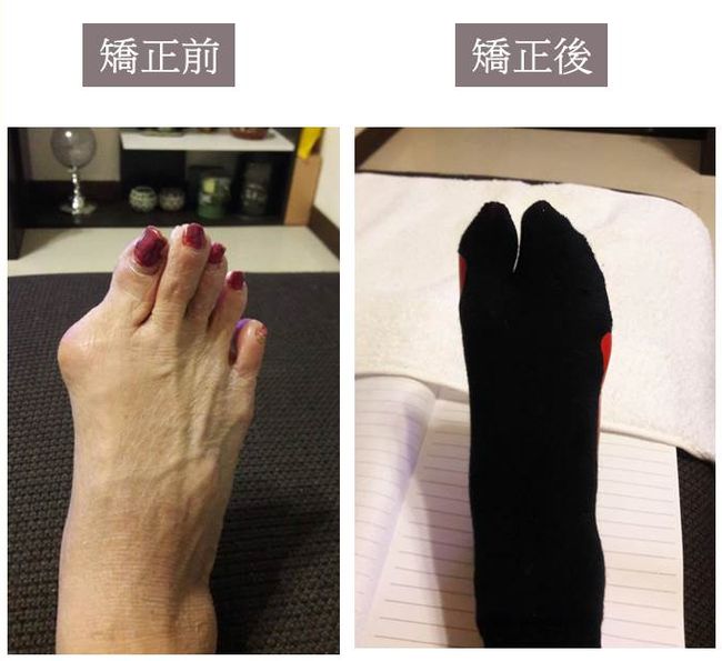 拇指外翻矯正輔具矯正襪