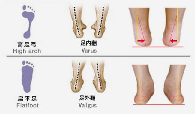 足內翻與足外翻