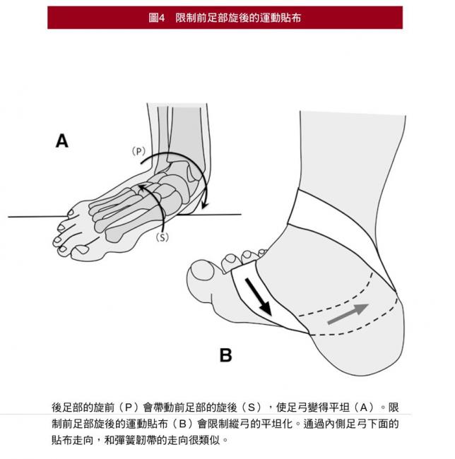 限制前足部旋後的運動貼布