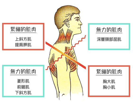 上交叉症候群示意圖