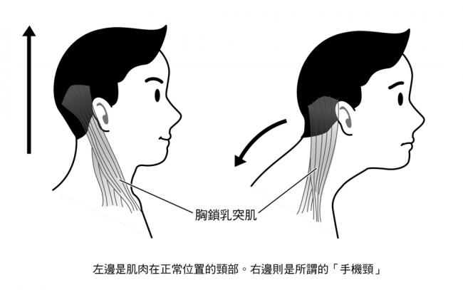 左邊是胸鎖乳突肌在正常位置的頸部，右邊則是所謂「手機頸」
